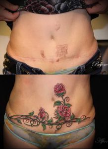 фото Тату на шраме, рубце, следе (tattoo) (значение) - пример рисунка - 011 tatufoto.com