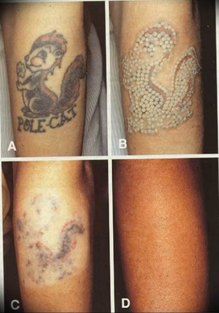 Удаление тату лазером - Laser tattoo removal - фото 1