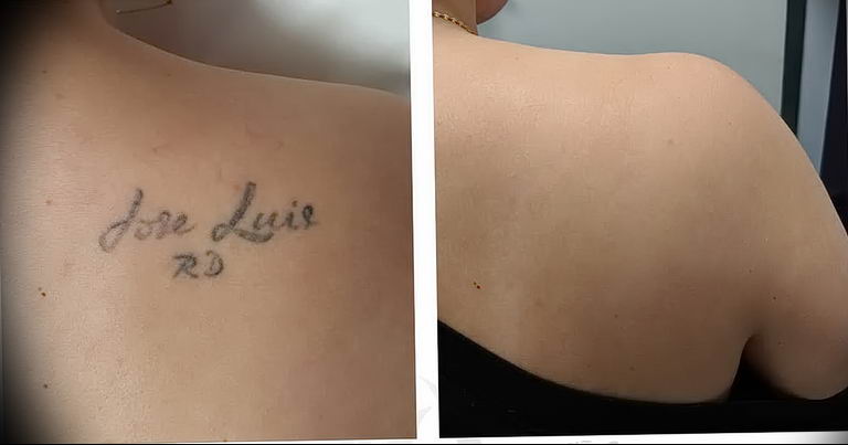 Удаление тату лазером - Laser tattoo removal - фото 2