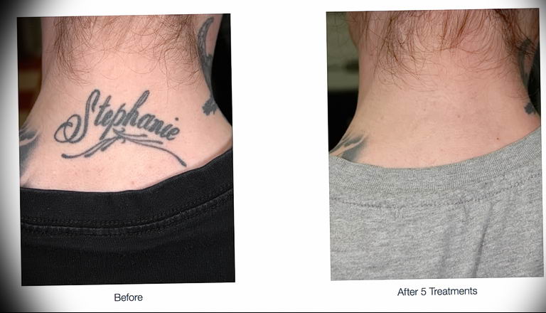 Удаление тату лазером - Laser tattoo removal - фото 3
