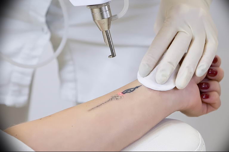 Удаление тату лазером - Laser tattoo removal - фото 4