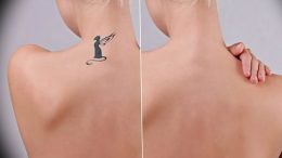 Удаление тату лазером - Laser tattoo removal - фото 5