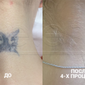 Лазерное удаление татуировок в Москве - фото
