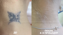 Лазерное удаление татуировок в Москве - фото