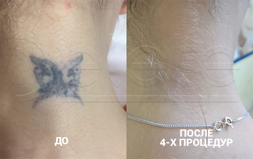 Удаление Татуировок Лазером Москва Цены